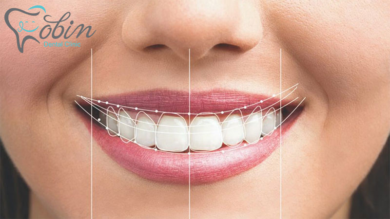 لمینت دندان؛ بهترین روش برای اصلاح طرح لبخند
